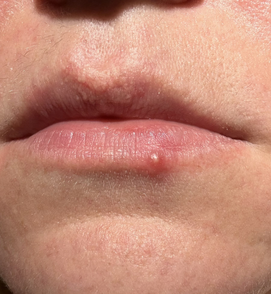 If it's not a cold sore, it's a....