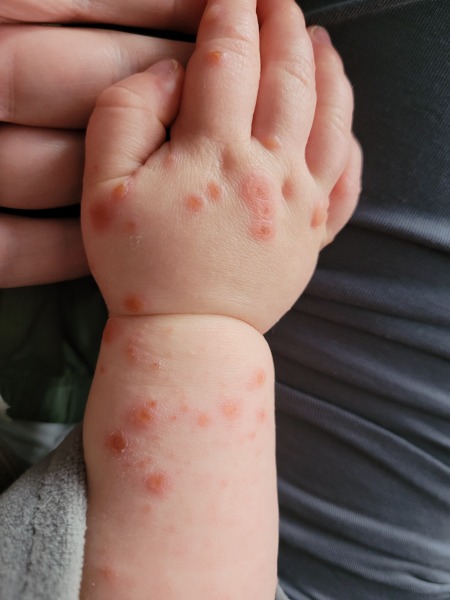 Chicken pox or hand foot and mouth?