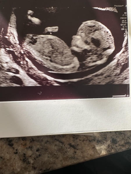 Is there a nub here?! And if so, girl or boy?