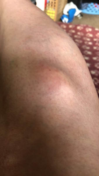 My leg just exploded!