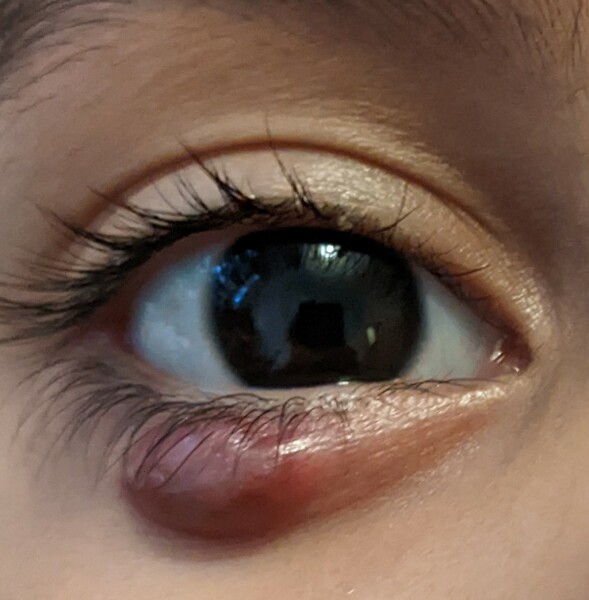 Chalazion getting dark (Photo)