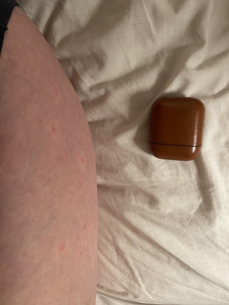 Could this be scarlet fever?