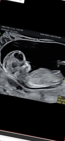 13 week scan … guesses please!