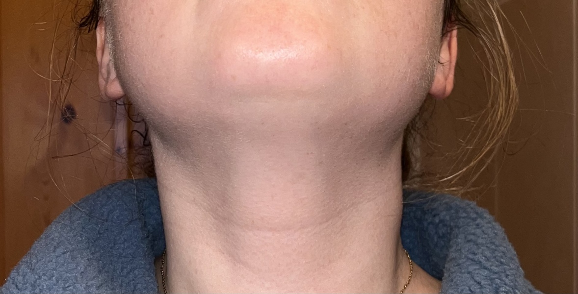 Swollen neck?? Any help??