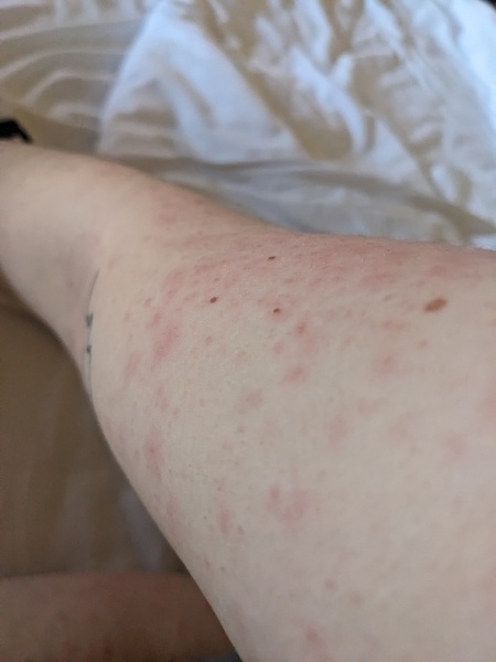 Itchy rash. Hives? Please help