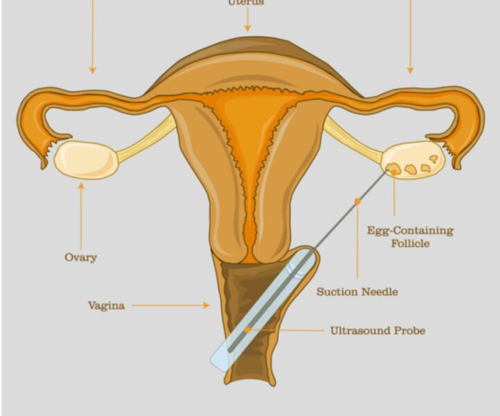 Egg Donation - Preferences