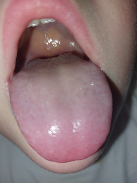 Strawberry tongue