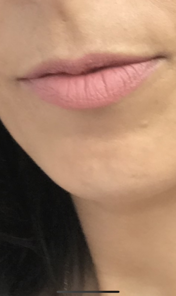 What is with lip fillers?!? They look so fake and awful