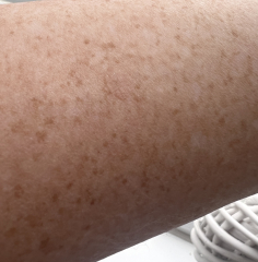 Is this mark Seborrheic Keratosis?