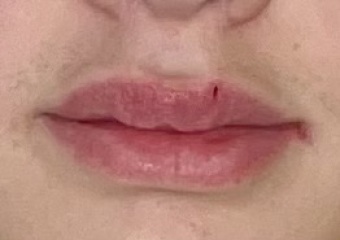 Lip filler everywhere