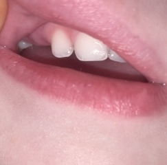 Intermittent temperature