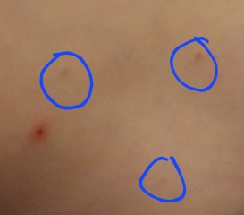 to ask what the hell is going on with flipping chicken pox?!