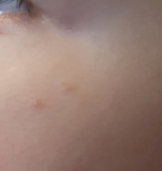 to ask what the hell is going on with flipping chicken pox?!