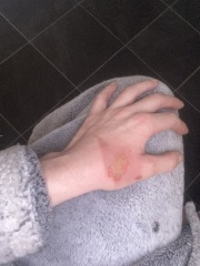 Does the burn on my hand look infected to you? (Photo attached)