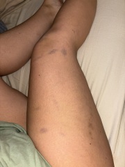 Sudden bruising and odd rash?
