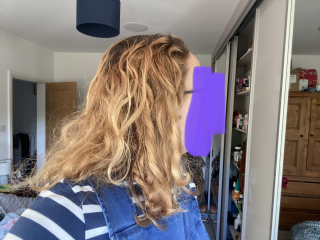 Anyone else's skin and/or hair gone to absolute shit? Warning: gross pic
