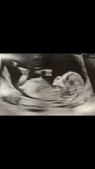 Nub or umbilical cord ?