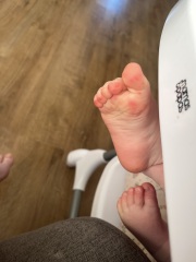 Is this chicken pox or hand foot and mouth?! 