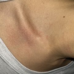 Does my collarbone look like a bulge? Or I am delusional r/AskDoctorSmeeee - Does my collarbone look like a bulge? Or I am delusional r/AskDoctorSmeeee - Does my collarbone look like a bulge? Or I am delusional