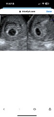 6 weeks scan - gestational sac/yolk sac but no fetal pole.