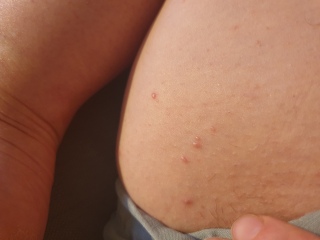 What are these lumps?