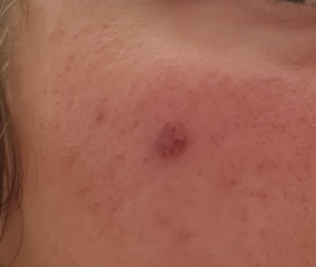Weird spot/pimple on cheek