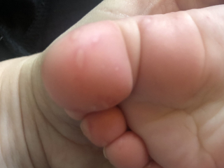 Hand, Foot & Mouth.