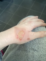 Does the burn on my hand look infected to you? (Photo attached)