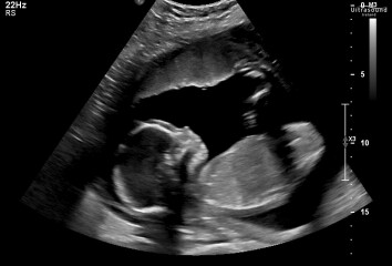 20 week scan boy or girl ?