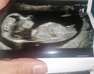 What is this on ultrasound?