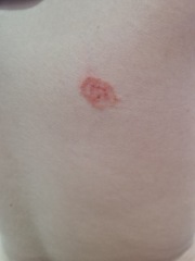 Help.. What are these bites?
