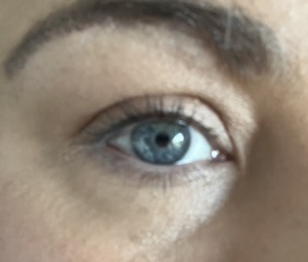 Any cosmetic nurses here? Pic attached -  Do I need Botox or tear trough filler?