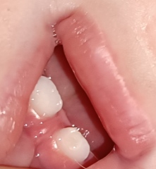 Baby tooth is the decay or damage 😬