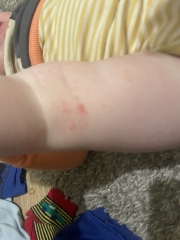 Not sure where to post does this look like chickenpox