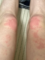 Please advise: urticaria