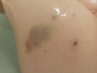 Fragmin injections bruising