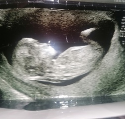 What is this on ultrasound?