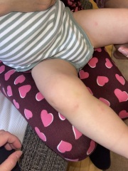 Spots on 17m old