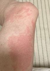 Please advise: urticaria