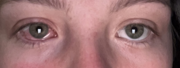 My poor eye