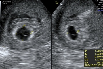 6 weeks scan - gestational sac/yolk sac but no fetal pole.