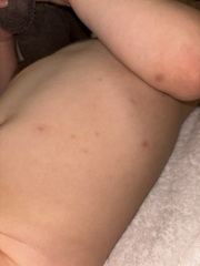 HELP! Toddler has had "chickenpox" since March