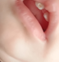 Baby tooth is the decay or damage 😬