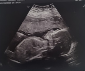 Nub theory - i have my 20 week scan tomorrow