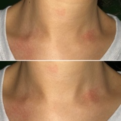 Does my collarbone look like a bulge? Or I am delusional r/AskDoctorSmeeee - Does my collarbone look like a bulge? Or I am delusional r/AskDoctorSmeeee - Does my collarbone look like a bulge? Or I am delusional