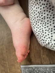 Is this chicken pox or hand foot and mouth?! 