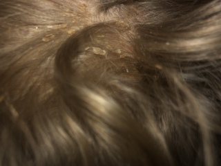 To ask what this could be on my DD scalp and hair?