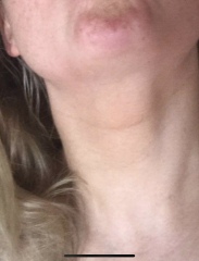 Swollen neck?? Any help??