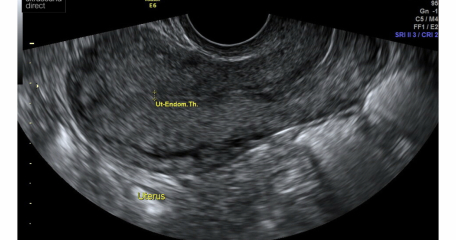 Advice on attached ultrasound