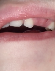 Intermittent temperature